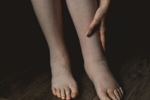 Swollen legs