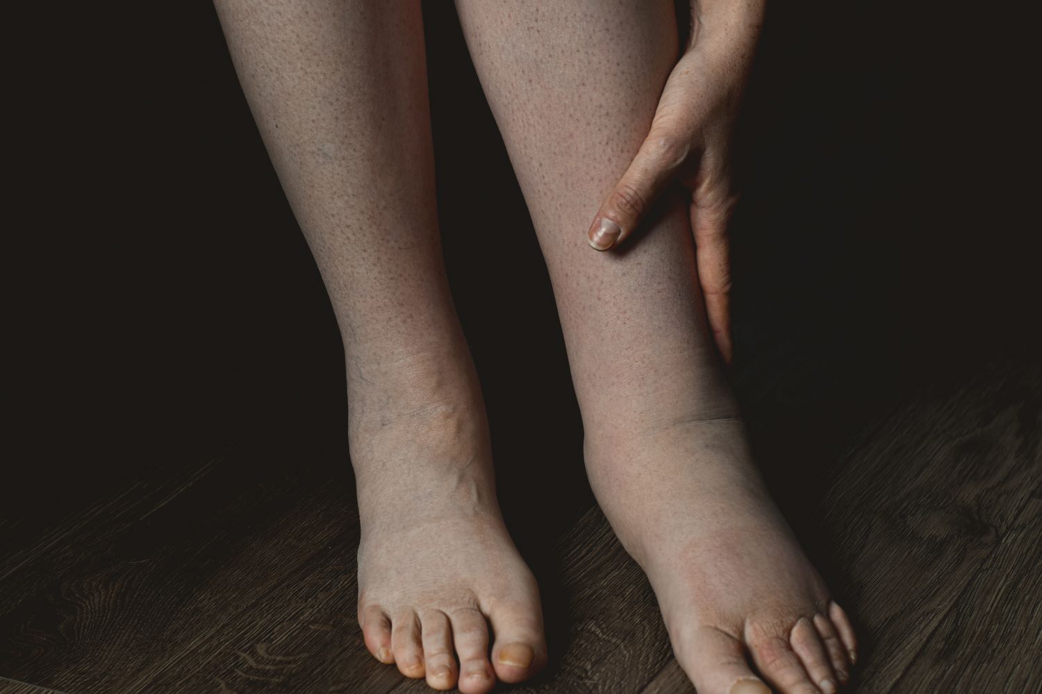 Swollen legs